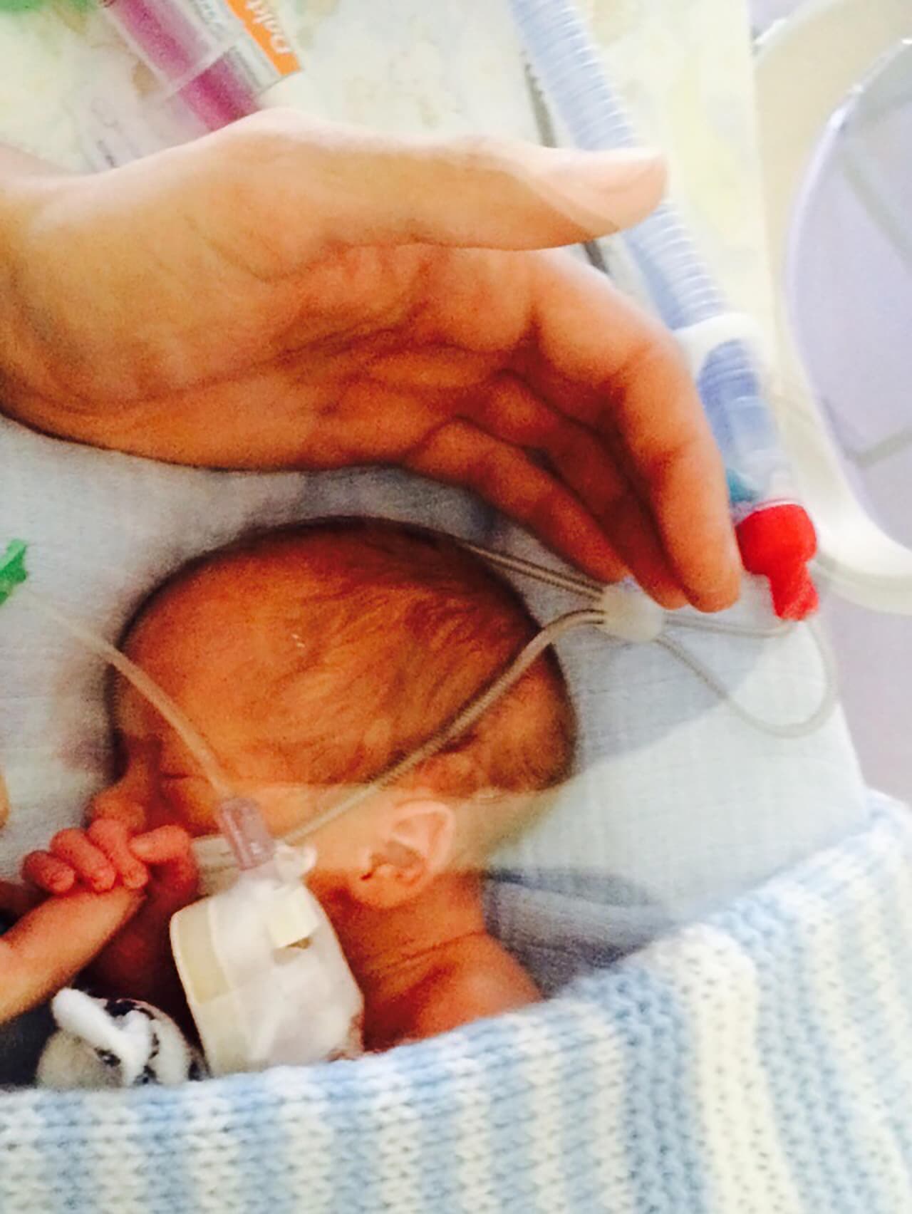 La cirugía se trató de un procedimeinto con laser para lograr dividir la placenta y así darle a cada bebé un 30 por ciento de supervivencia.