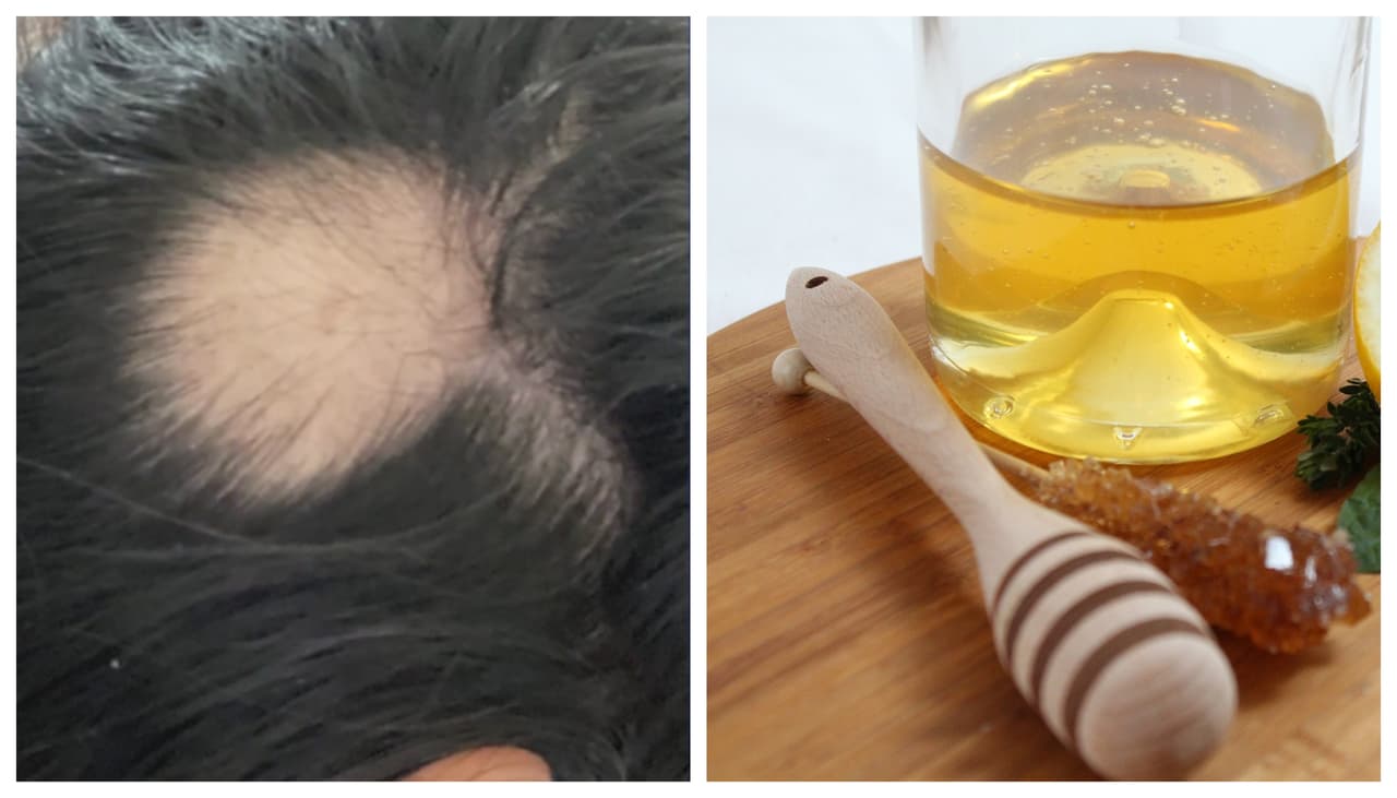 ¿Sirven los remedios caseros para tratar la pérdida de cabello después del covid-19?: Una doctora aclara 