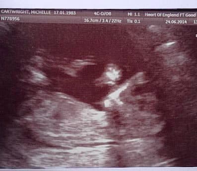 “Después de la operación me dijeron que hay un 99.9% de probabilidad de que el cáncer haya desaparecido, pero iré a chequeos cada tres meses”, aseguró.