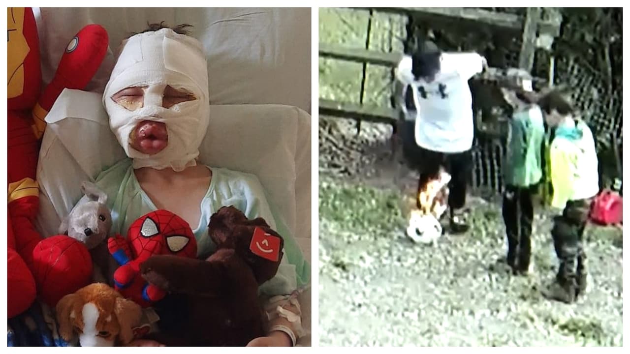 Policía de Connecticut dice que el niño Dominick Krankall no fue quemado por otros niños
