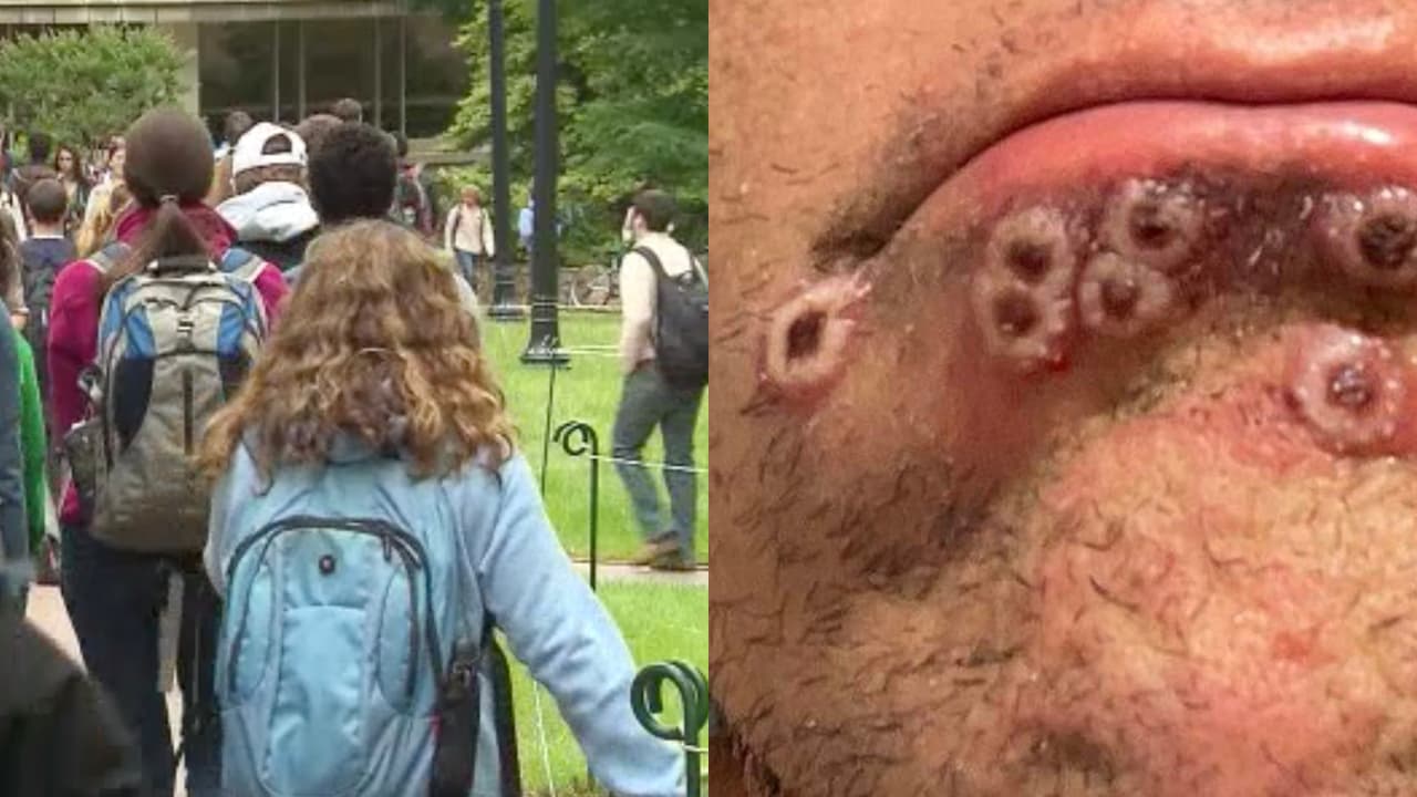 “No hay amenaza entre los niños”: experto habla sobre el riesgo de la viruela del mono en este regreso a clases