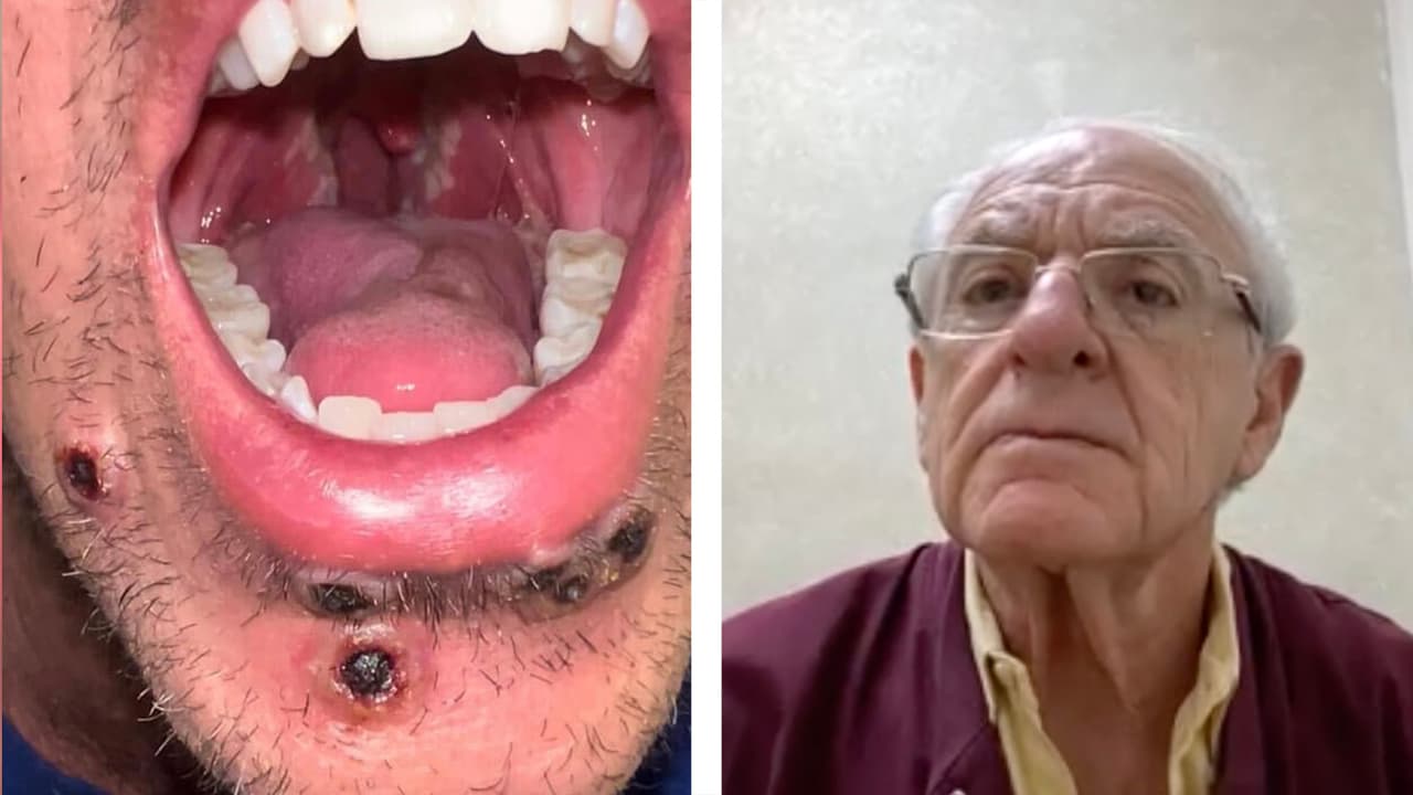 "La enfermedad les va a dar inmunidad": Médico explica quiénes se deben vacunar contra la viruela del mono