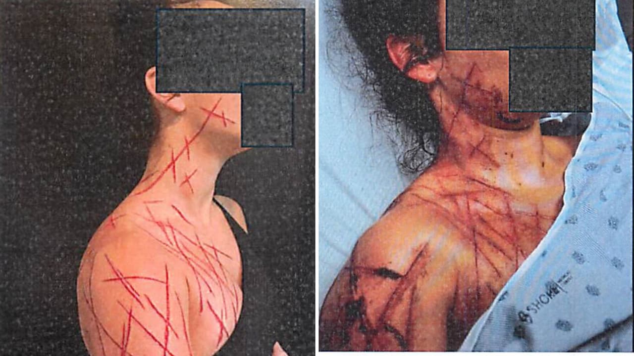 Izquierda: Fotografías tomadas por el artista de escarificación en Pensilvania el 23 de julio de 2025 a las 6:09 p.m., mostrando las laceraciones recién realizadas en el rostro, cuello, pecho superior y hombro de Natalie Greene. Derecha: Las mismas heridas documentadas por personal médico en el hospital más tarde esa noche. Los patrones coinciden exactamente, confirmando que las lesiones fueron resultado del procedimiento de modificación corporal, no de un ataque violento como Greene alegó a las autoridades.