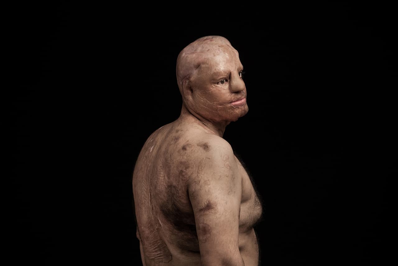 El acto violento de ataques con ácido es principalmente contra las mujeres y los niños. Estos ataques son cometidos con la intención de desfigurar, mutilar y destruir la vida social y el futuro de la víctima. Las víctimas se enfrentan a la experiencia de estigma social, la culpa y etiquetas sociales