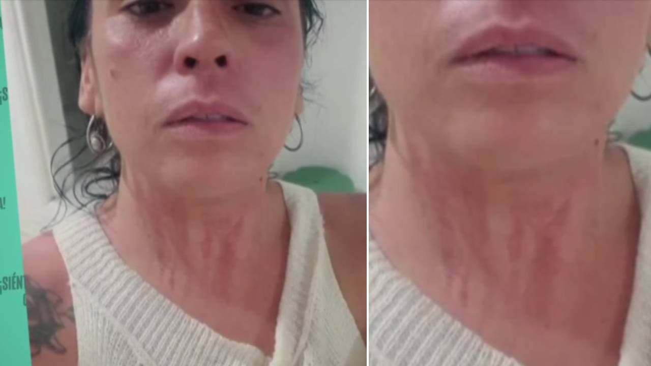 Mayela Laguna mostró las marcas que le dejó el intento de ahorcamiento del que fue víctima.