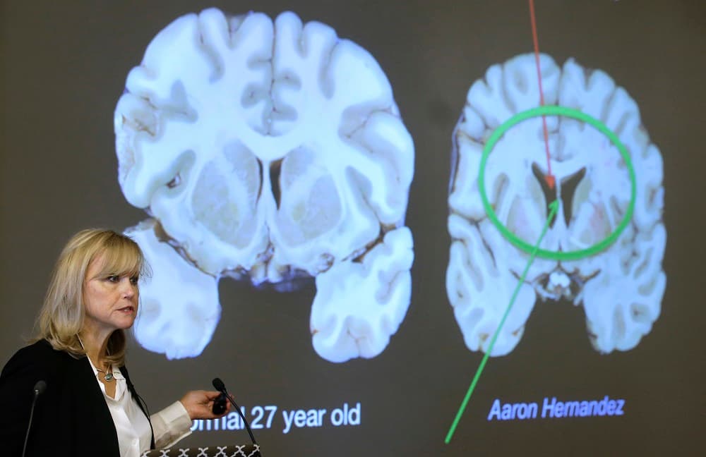 Ann McKee, director Boston University's center for research into the degenerative brain disease chronic traumatic encephalopathy, or CTE, addresses an audience on the school's campus Thursday, Nov. 9, 2017 about the study of NFL football player Aaron Hernandez's brain, projected on a screen, behind right, in Boston. McKee says Hernandez suffered severe damage to parts of the brain that play an important role in memory, impulse control and behavior. The cross section of the brain projected behind left is labeled a normal 27 year old. (AP Photo/Steven Senne)