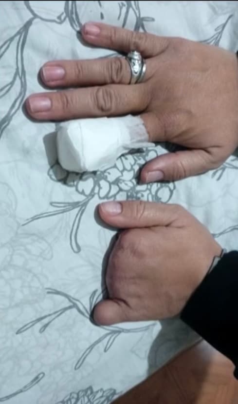 Al igual que sus pies, la mujer también tenía grados de necrosis en ambas manos, todo a raíz de una grave infección ocasionada por el covid-19, la cual no permitía que el oxígeno llegara a dichos lugares. 
<br>