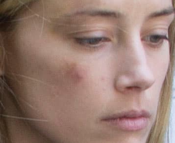 Mostró ante las cámaras las supuestas marcas de las agresiones de Depp.