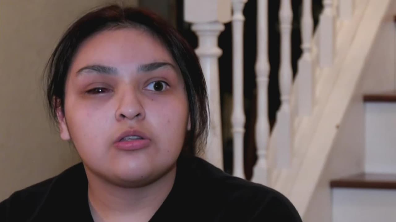 <b>Joven latina pierde un ojo tras ser golpeada por defender a un niño con discapacidad; su familia pide ayuda</b>
<br>
<br>Ante la imposibilidad de salvarle el ojo, los especialistas le recomendaron extraerle el órgano dañado y sustituirlo con una prótesis. Ahora, su familia busca fondos para cubrir los gastos médicos.