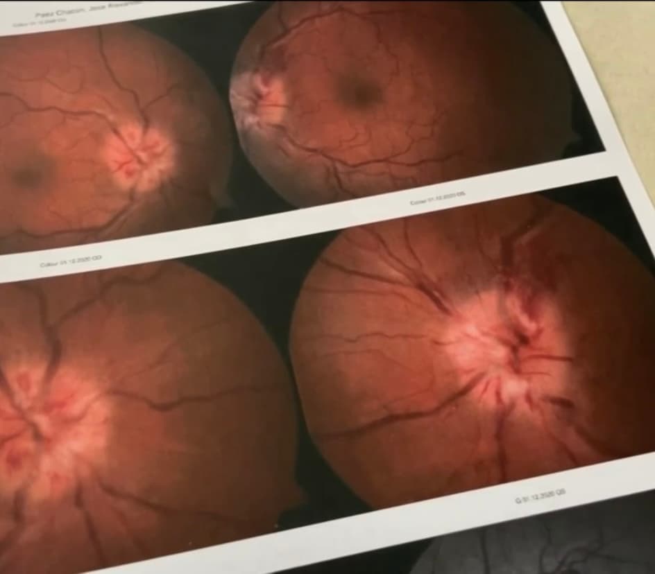 “Me dijeron que el nervio óptico se había dañado y que había células que no se iban a regenerar, 
<b>por lo que tenía que aprender a vivir con ello”</b>, cuenta un afligido Alexander. 
<br>