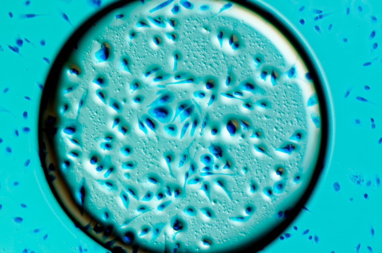 El PSA es un examen de sangre que mide la concentración de una proteína producida por las células de la glándula prostática que luego se envía a un laboratorio para ser analizada.