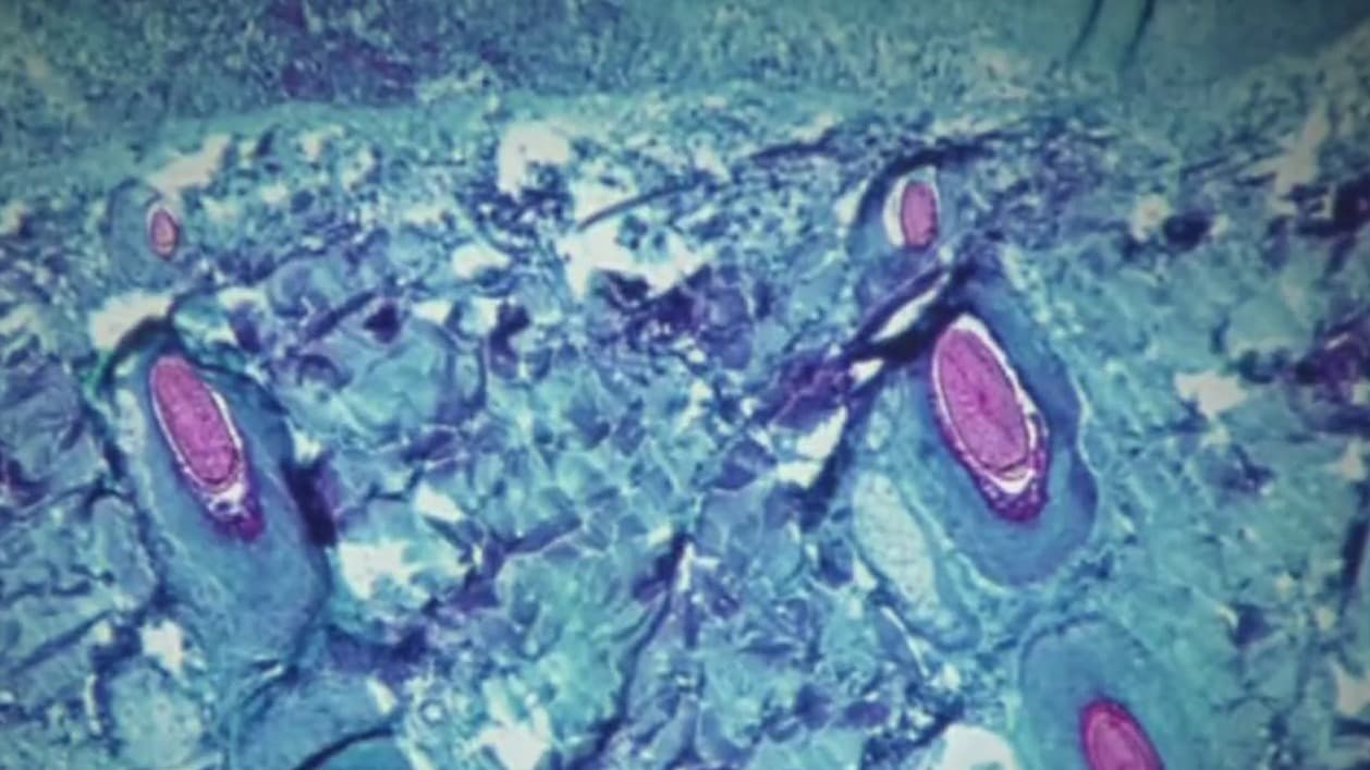 Confirman la primera muerte por viruela del mono en el condado de Los Ángeles