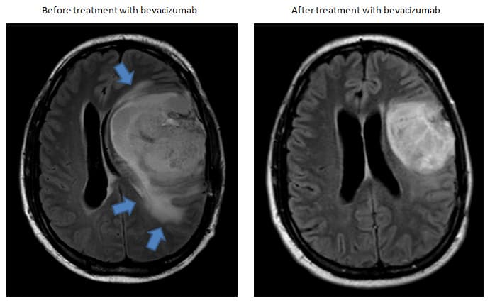 A pesar de los tratamientos, el cáncer se ha expandido por todo su cuerpo. La ayuda proporcionaría a este tipo de enfermos la opción de solicitar a su doctor un medicamento para morir pacíficamente en su sueño, si ya no pueden más con el sufrimiento.