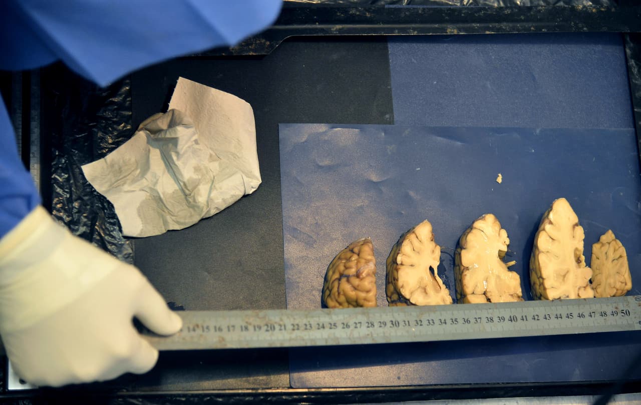 La estimulación con luz de las células cerebrales ha sido usada previamente en tratamientos para enfermedades mentales como la depresión y el trastorno de estrés postraumático.