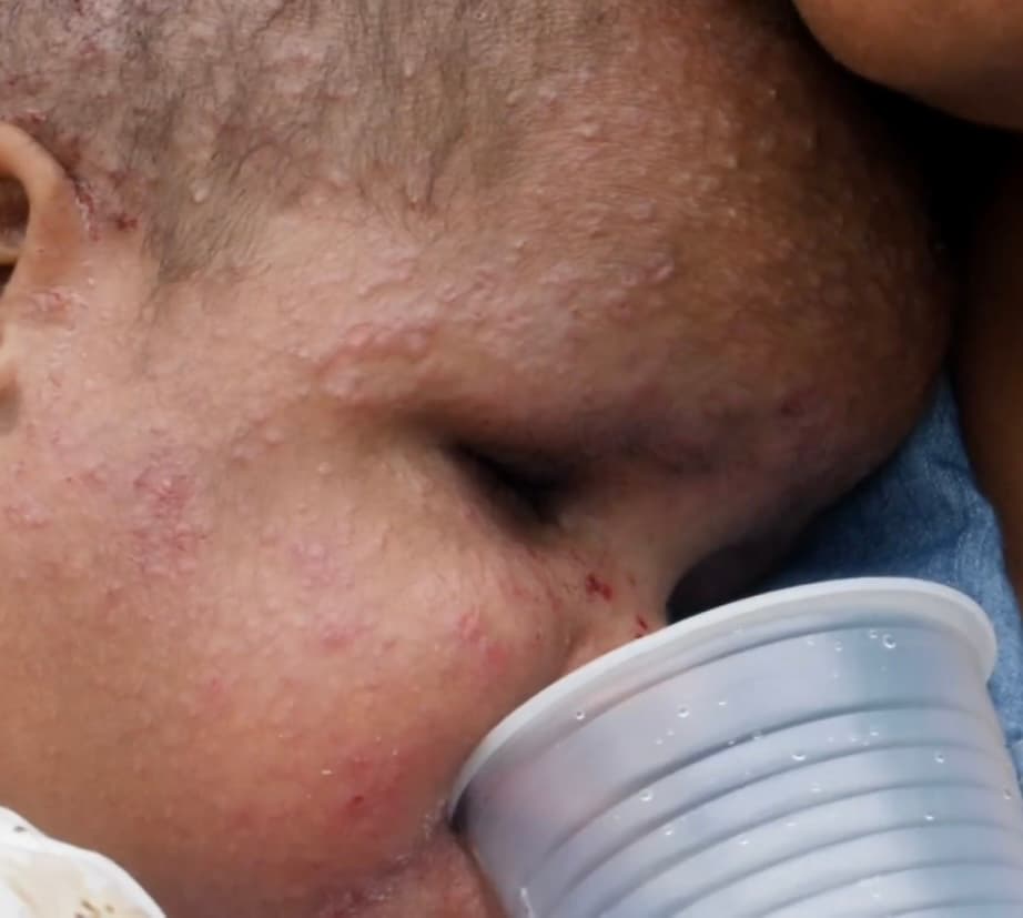 La falta de dinero ha provocado que, en los últimos tres meses, la niña no haya podido ser atendida en sus problemas médicos, sobre todo porque el sueldo de Pamela no supera los 160 dólares mensuales. 
<br>