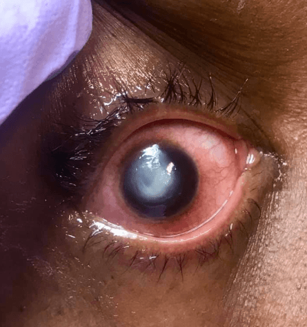 Los daños oculares pueden ser irreversibles advierte Vollmer en su post que ha sido compartido por más de 300,000 personas.