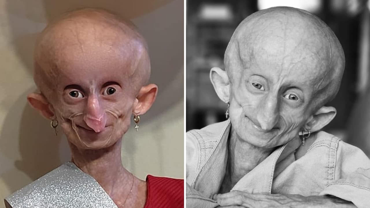 Muere ‘tiktoker’ Beandri Booysen a los 19 años: tenía un trastorno que la hizo envejecer antes