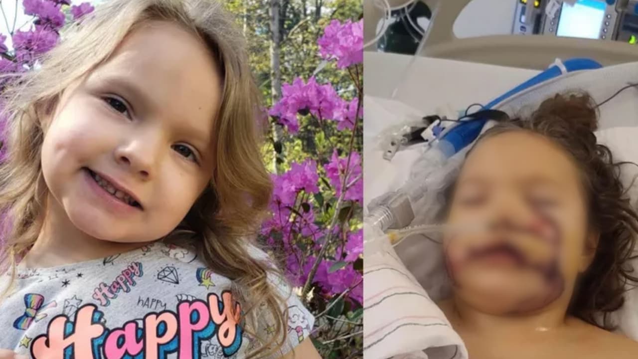 "No volverá a sonreír": operan a una niña de seis años que fue atacada brutalmente en la cara por un perro