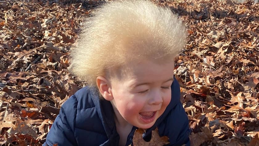 El pequeño Locklan Samples, de 10 meses, quien tiene el síndrome del 'cabello despeinado'.