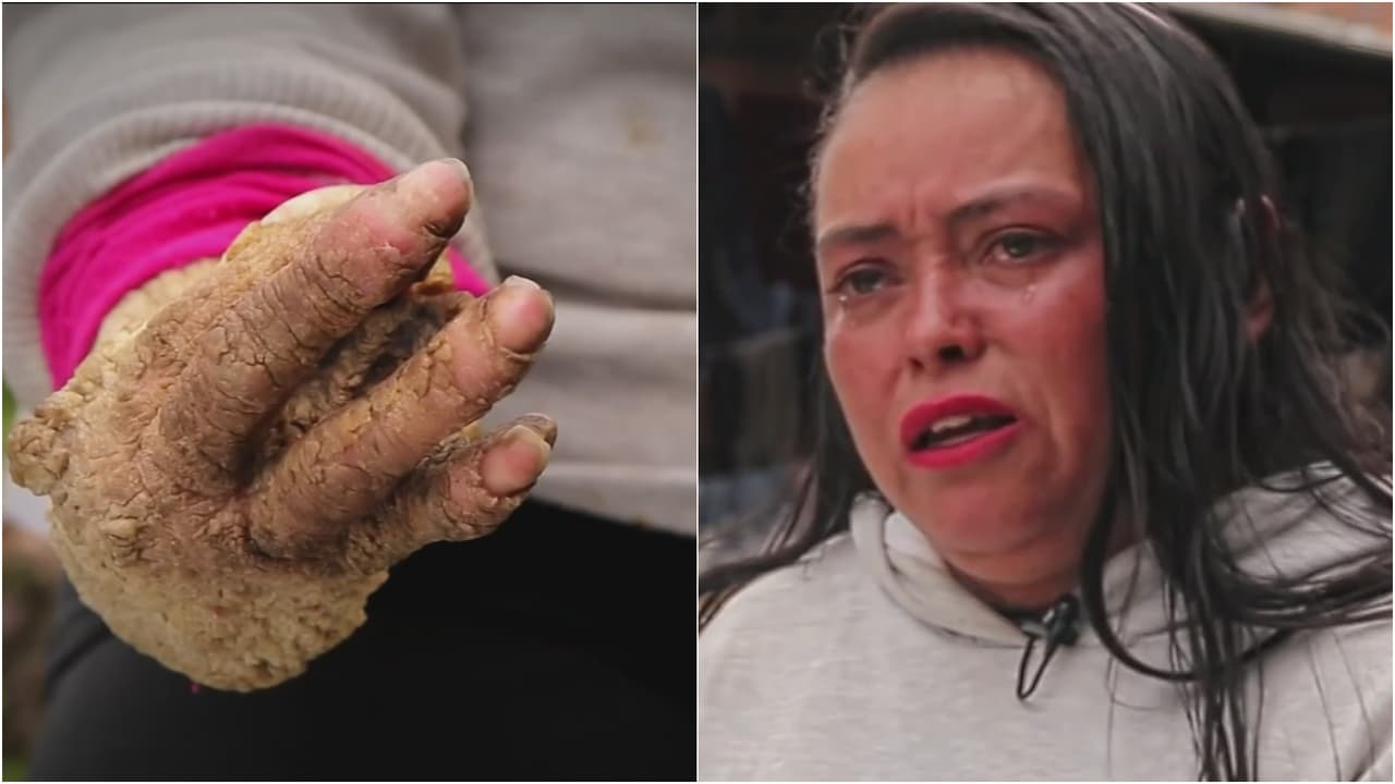 <b>Mira el caso completo y haz <a href="https://www.univision.com/shows/primer-impacto/ayuda-de-impacto-esta-madre-sufre-de-una-rara-enfermedad-que-le-convierte-la-piel-en-costras-duras-colombia" target="_blank">clic aquí para saber cómo ayudarla</a></b>.