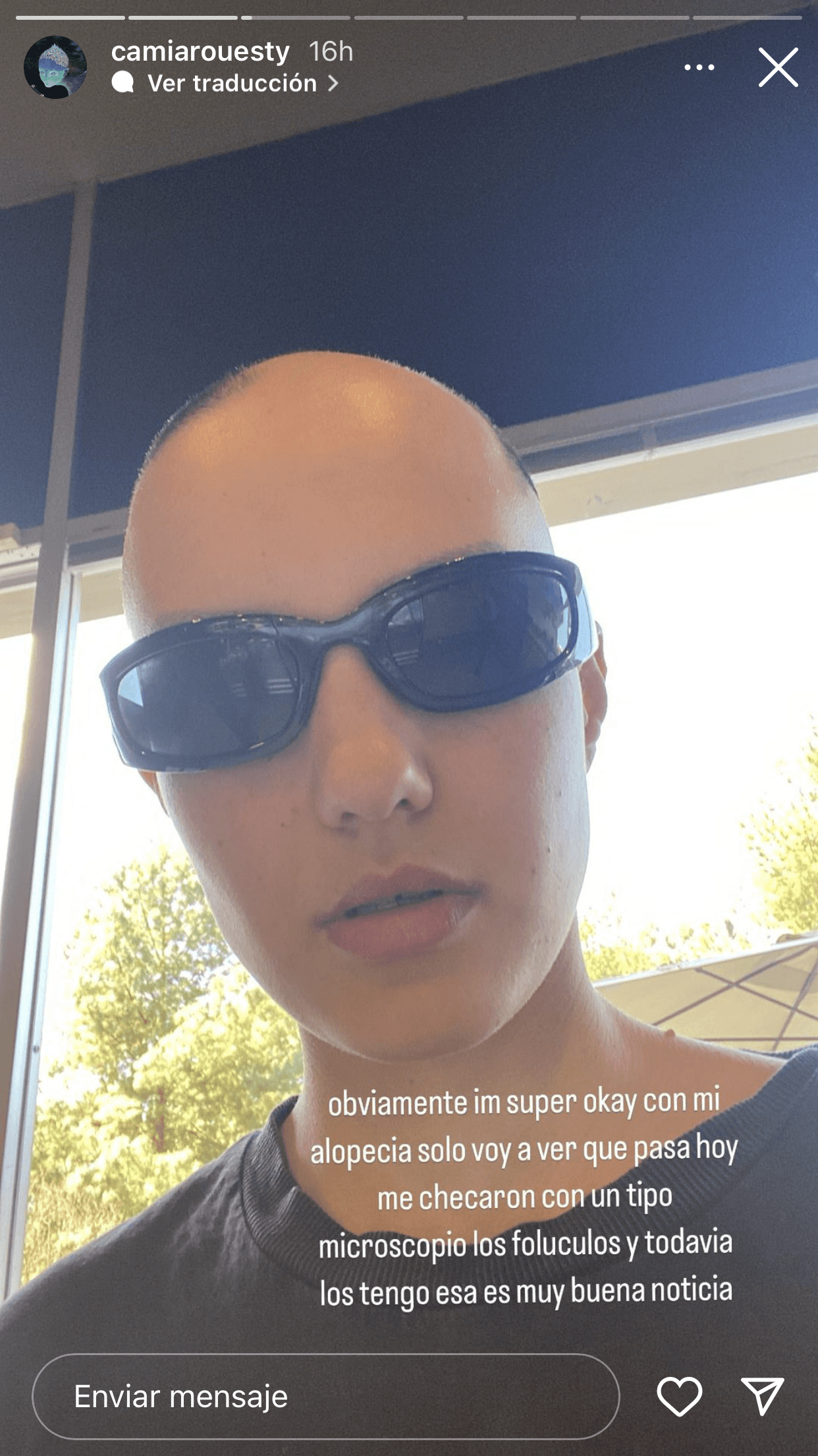 La novia de Camilia Araiza aclaró que tomar el tratamiento no significa que no se acepta tal y como es, sino que quiere "ver qué pasa" ahora que recibió la buena noticia de que conserva sus folículos pilosos, que es en donde nace el cabello.