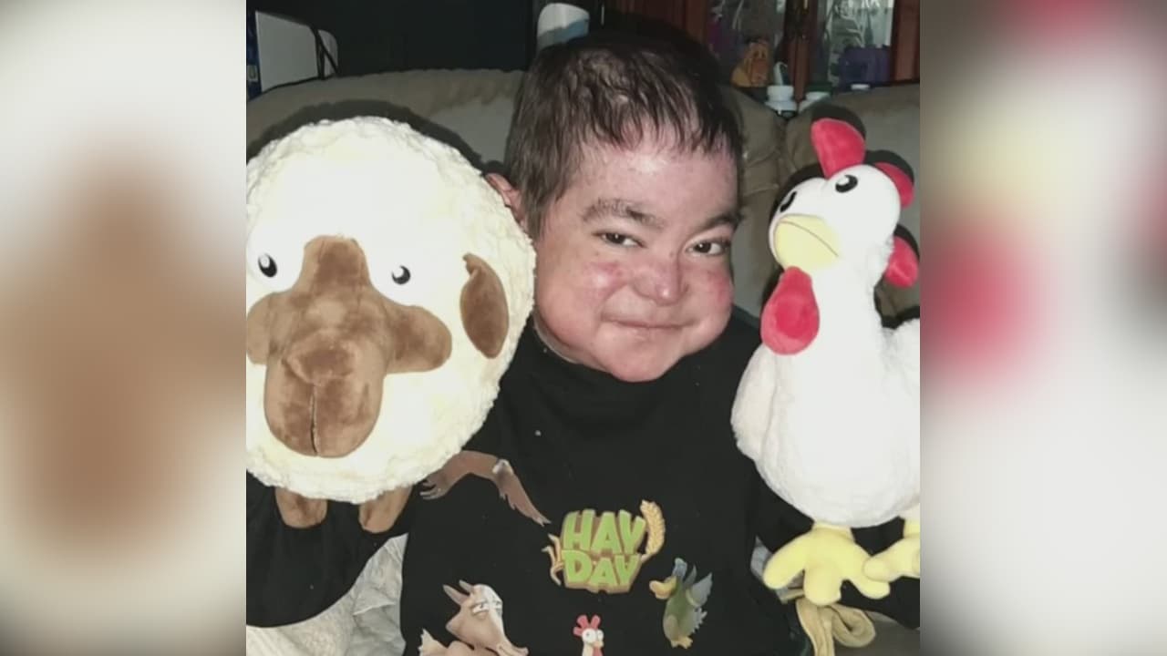 <b>Este joven de 18 años con 'piel de mariposa' solo pide volver a escuchar la voz de su mamá</b>
<br>
<br>La rara enfermedad le ha afectado gravemente sus oídos, pero él no pierde la esperanza de recuperar este sentido. Si quieres saber cómo ayudarlo en Venezuela ingresa a 
<b><a href="https://www.univision.com/shows/primer-impacto/ayuda-de-impacto-este-joven-sufre-de-piel-de-mariposa-y-suena-con-volver-a-escuchar-venezuela" target="_blank">este enlace</a></b>.