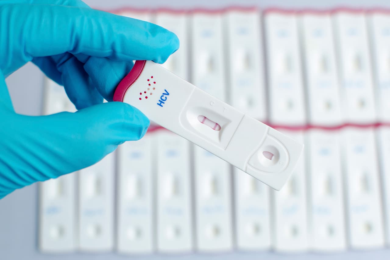 Detectan caso de hepatitis A en un trabajador de restaurante del condado de Gwinnett