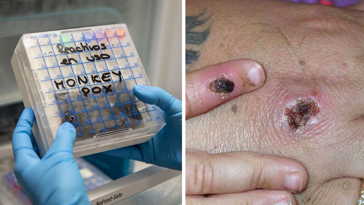 Confirman el tercer caso de la viruela del mono en Houston: el paciente está aislado