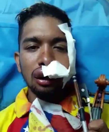 Wuilly Arteaga was injured in a protest in July and then held 19 days in jail. He was released Aug 15.