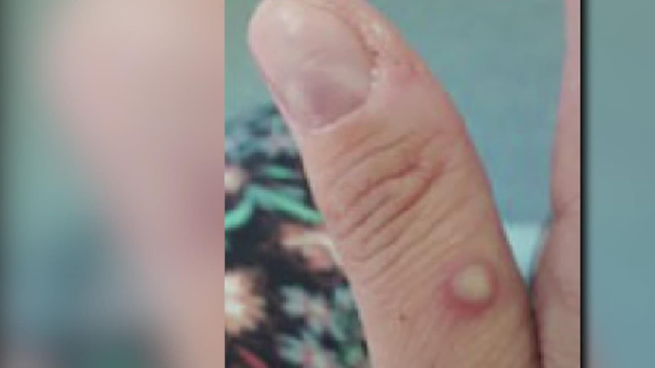 ¿Quiénes son las personas con mayor riesgo de contagiarse de la viruela del mono?