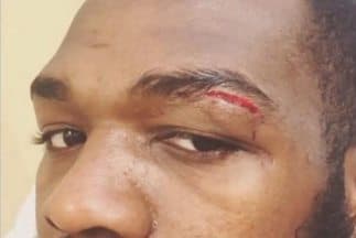 Jon Jones se cortó la ceja durante entrenamiento