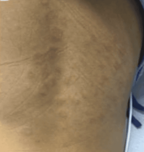 Otros síntomas son fiebre, ronchas, ojos y bocas rojas, fuerte dolor abdominal, vómitos.