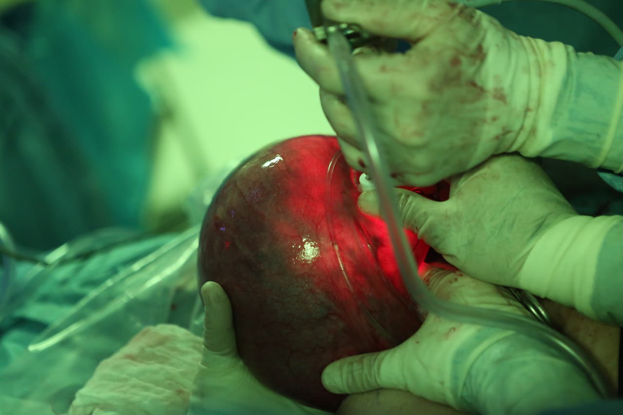 A este bebé con espina bífida lo operaron antes de nacer y prácticamente sin abrir el útero