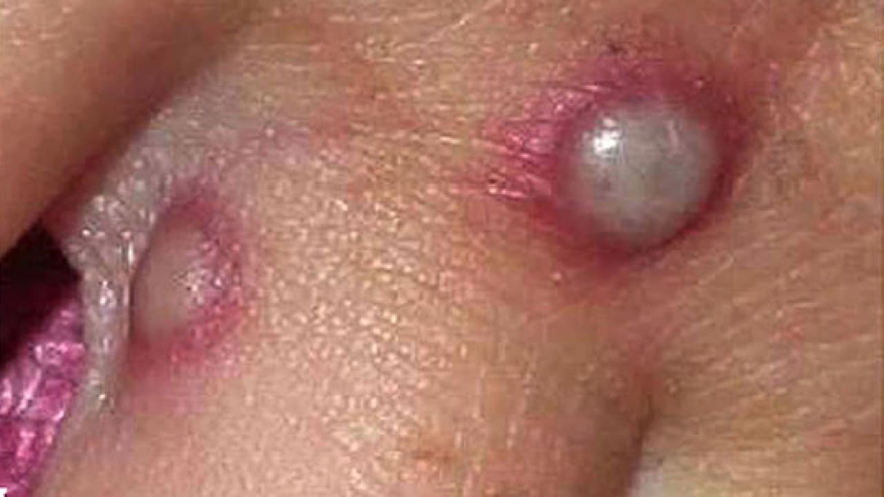 Reportan un segundo caso de la viruela del mono en el condado Tarrant