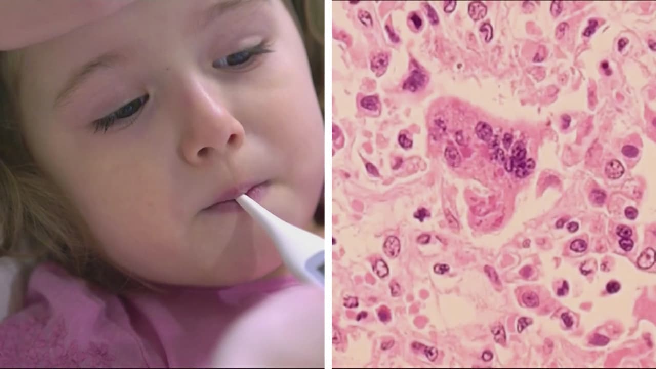 Detectan caso de sarampión en el norte de Virginia; Fairfax y Loudoun alertan por exposición