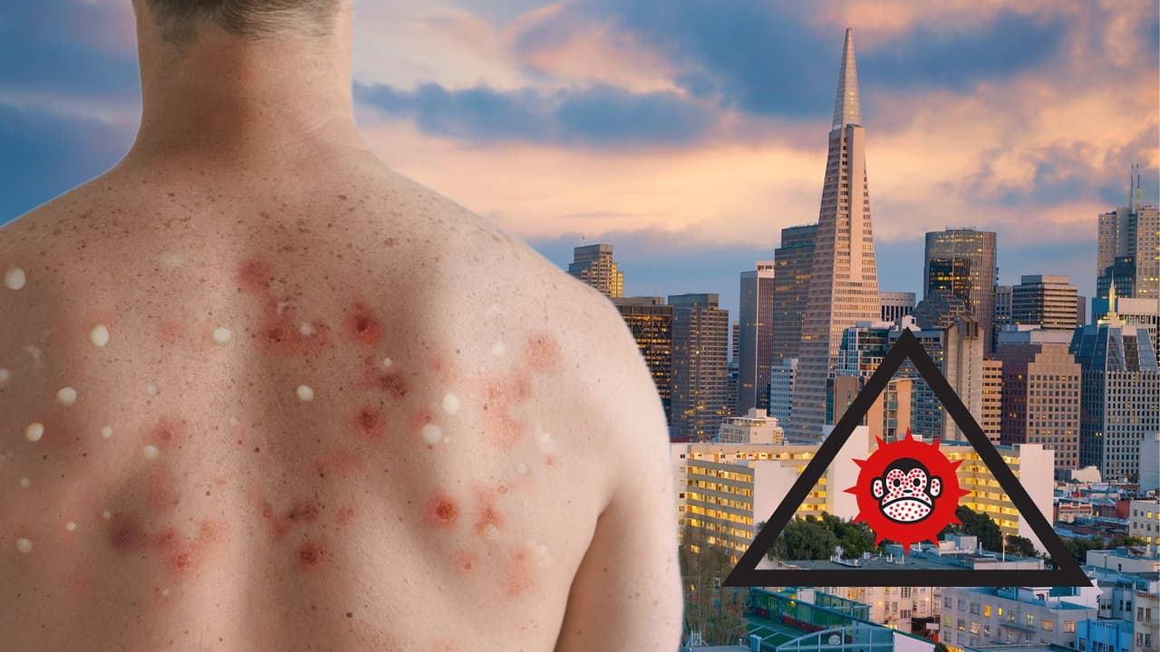 San Francisco es la zona de California con más casos de viruela del mono