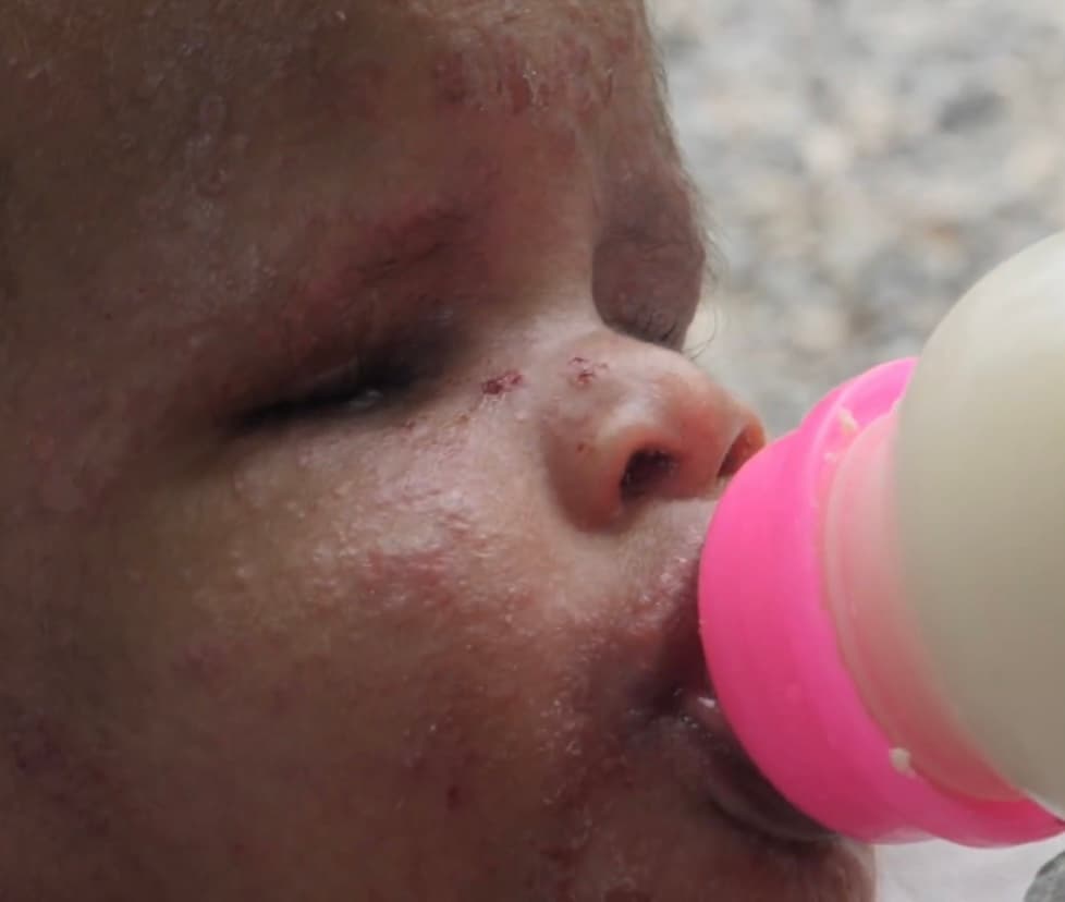 La angustia de una familia entera se instaló en sus vidas cuando especialistas en Alemania, que recibieron los resultados de varias pruebas que le hicieron a niña, determinaron que no existía una causa para que la pequeña haya nacido sin ojos. 
<br>