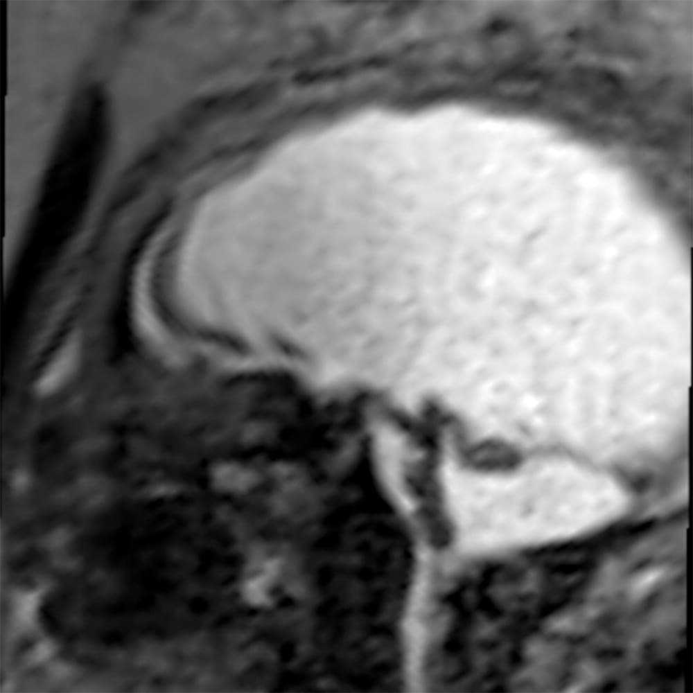 El bebé desarrolló una ventriculomegalia severa (sus ventrículos se llenaron de líquido) en el tercer trimestre, por lo que el tamaño de su cabeza, en vez de reducirse, aumentó.