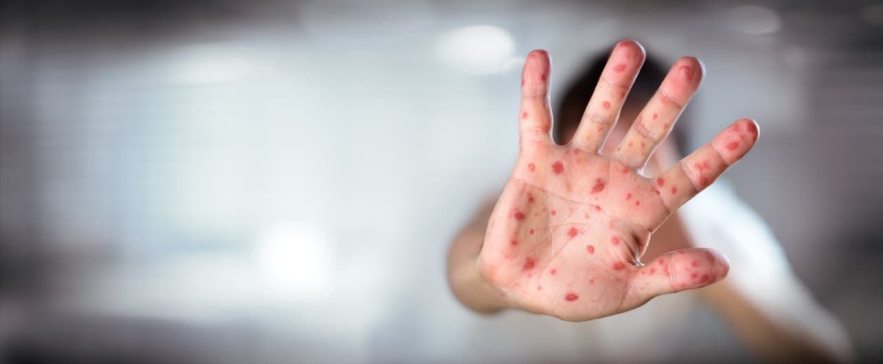 Todos los pacientes en Utah 
<b>son personas no vacunadas</b>. La vacuna es la forma más eficaz de prevenir la enfermedad, destacan las autoridades sanitarias.