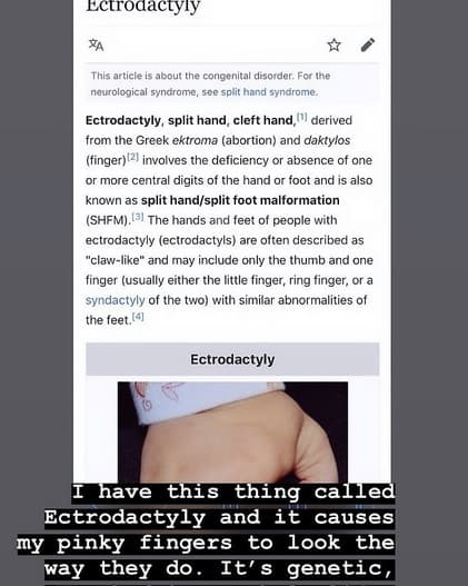 Luego, la esposa de Justin Bieber publicó una captura de la página de Wikipedia en la que se explica la ectrodactilia, un padecimiento que también se le conoce como síndrome EEC. 
<br>