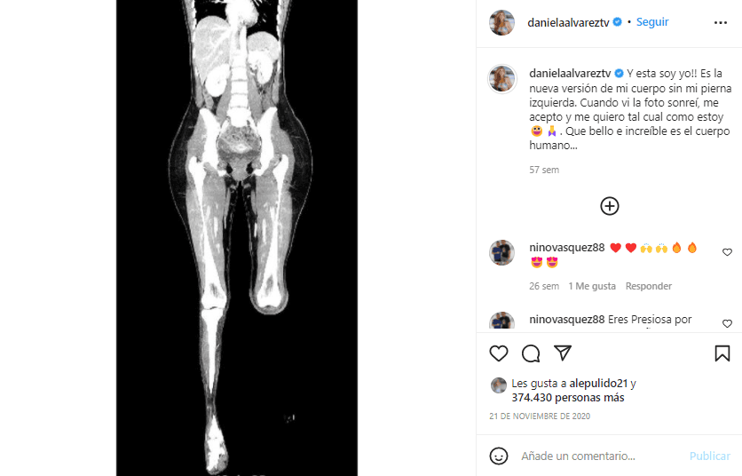 Daniella Álvarez mostró la amputación de su pierna