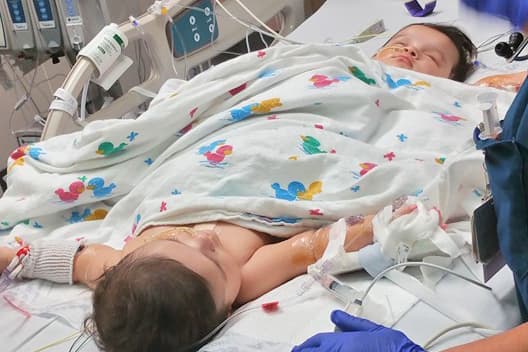 Lo último sobre la separación de las siamesas texanas Ximena y Scarlet Hernández