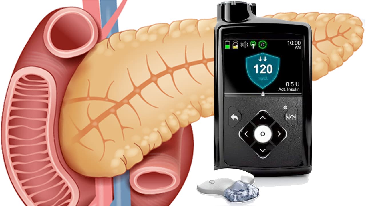 El primer dispositivo automatizado de insulina promete noches más seguras para las personas con diabetes tipo 1