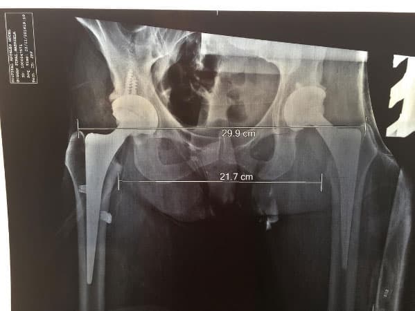 Ahora tiene una protésis de titanio en la cadera para el resto de su vida, aunque eso no intervendrá en sus actividades, al contrario, la ayudará a tener mejor movilidad.