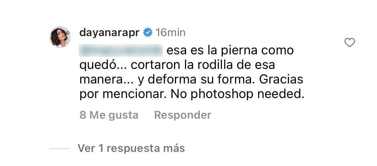 Dayanara Torres se defendió:
<b> "Esa es la pierna como quedó"</b>, le explicó, "cortaron la rodilla de esa manera… y deforma su forma". 
<br>