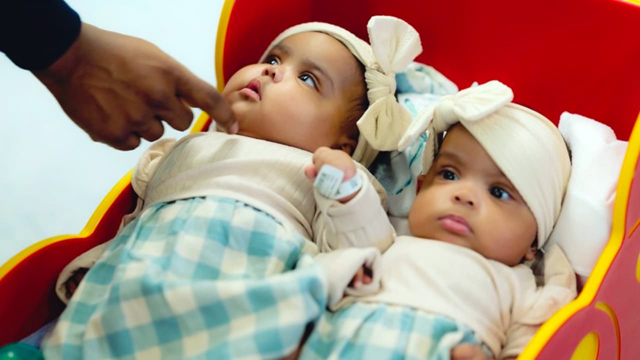 Momento en que las gemelas Jamie y Amie Lynn salen del Cook Children´s en el norte de Texas.