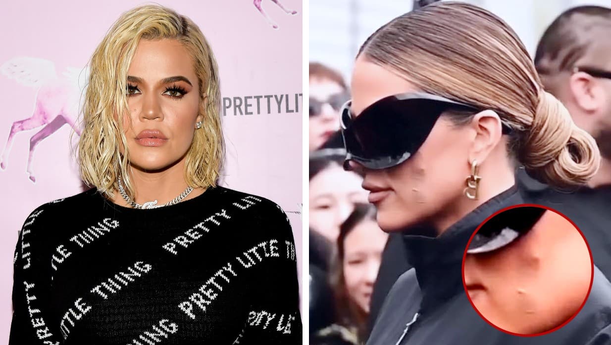 Khloé Kardashian revela el misterio del parche en su rostro: le extirparon un tumor
