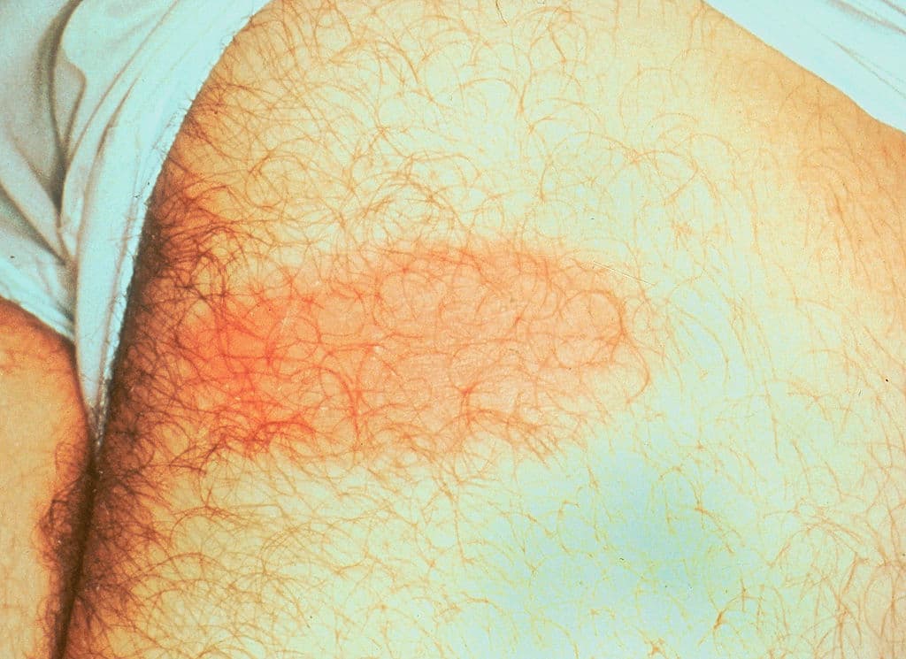 Las garrapatas son 
<a href="https://www.univision.com/local/chicago-wgbo/cuidado-con-las-garrapatas-se-alimentan-de-sangre-y-transmiten-una-peligrosa-enfermedad-video">portadoras de Lyme y otras enfermedades</a> debilitantes y en ocasiones mortales, como la fiebre maculosa de las Montañas Rocosas, la tularemia, la ehrlichiosis y la babesiosis.
<br>