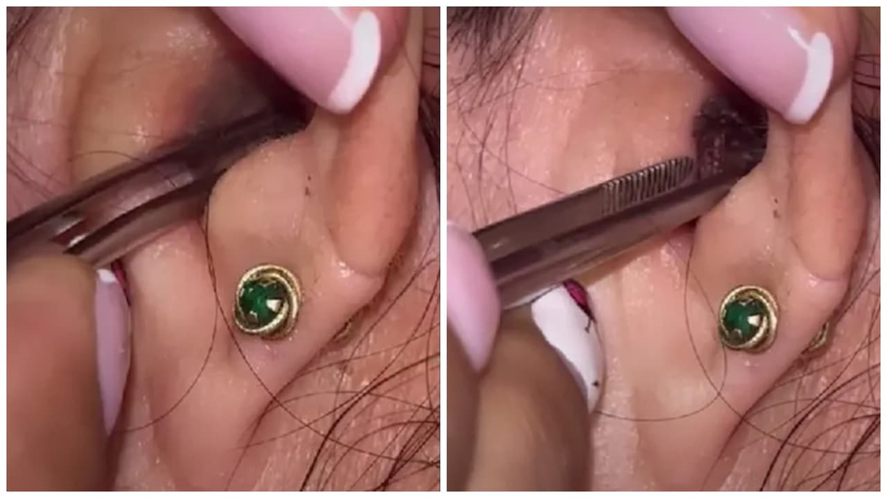 Joven va al doctor por molestias en su oído y lo que encontraron dentro impactó a Internet