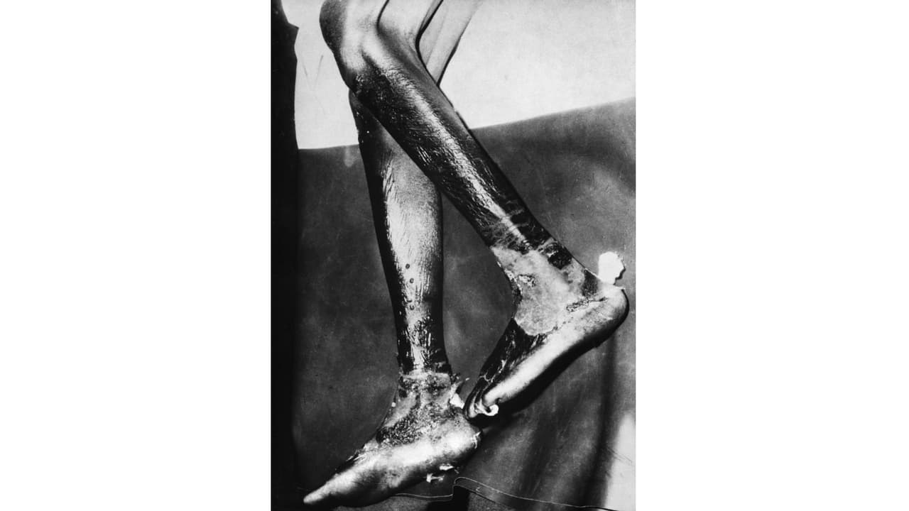 Efectos de la pelagra